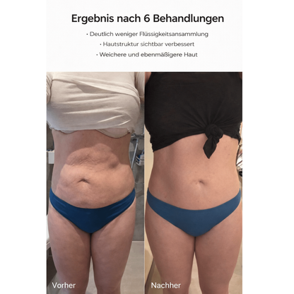 Cellusmooth EMS Anti-Cellulite-Massagegerät